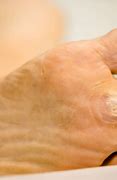 Image result for Flat Skin Warts