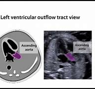 Image result for Left Ventricular Outflow Tract Stroke Volume