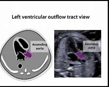 Image result for Right Ventricular Outflow Tract