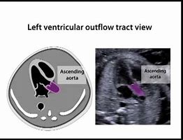 Image result for LVOT Rvot Ultrasound