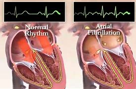 Image result for AFib Heart