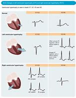 Image result for Right Ventricular Hypertrophy Echo