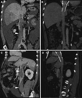 Image result for IVC Thrombs Post-Mortem