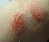 Image result for Scaly Rash