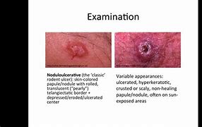 Image result for Squamous and Basal Cell Cancer