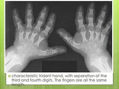 Image result for Trident Hand Achondroplasia