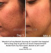 Image result for Banish Acne Scars