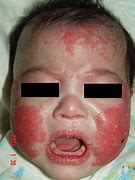 Image result for Kawasaki Virus Symptoms