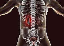 Image result for Kidney Cancer Tumor