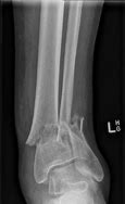 Image result for Open Pilon Fracture