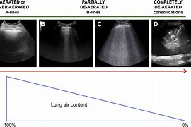 Image result for Lung Ultrasound B Lines Pulmonary Edema