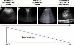 Image result for Pulmonary Regurg Ultrasound Flame