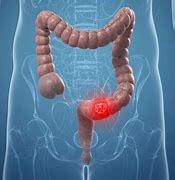 Image result for Human Body Colon Cancer