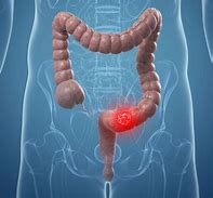 Image result for Pics of Colon Cancer