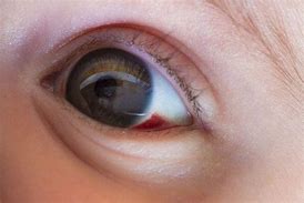 Image result for Red Spot On Eye