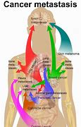 Image result for Cancer Bone Metastasis