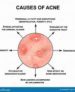 Image result for Pustules and Inflammatory Acne