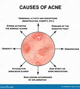 Image result for What Are Pustules On the Skin