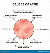 Image result for Pustules and Inflammatory Acne