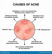 Image result for Infected Acne Pustules