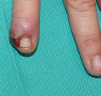 Image result for Ingrown Nail Tool