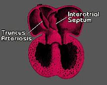 Image result for Interatrial Septum Formation