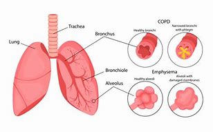 Image result for Emphysema Cartoon