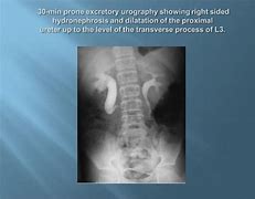 Image result for Retrocaval Ureter vs Normal