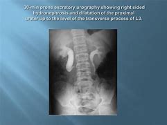 Image result for Retrocaval Ureter X-ray