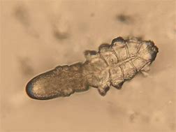 Image result for Demodex Mite Infestation