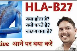 Image result for HLA-B27 Testing