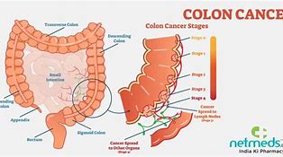 Image result for Human Body Colon Cancer