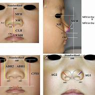 Image result for Nasal Alar Groove