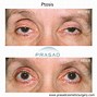 Image result for Liver Ptosis