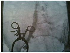 Image result for IVC Thrombs Post-Mortem