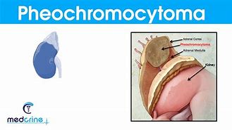 Image result for 5 Ps of Pheochromocytoma