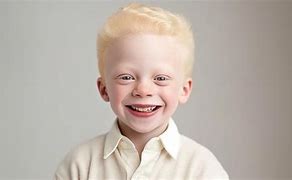 Image result for Albino Child