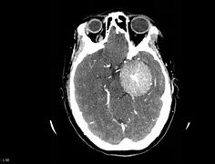 Image result for Meningioma CT Head