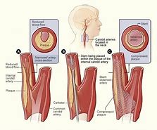 Image result for Carotid Artery Stenting