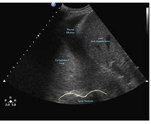 Image result for Lung Ultrasound Probe