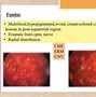 Image result for HLA Gene Uveitis