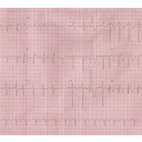 Image result for Sessile Thrombus