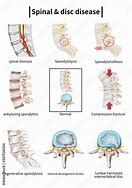 Image result for Spinal DIC Chart