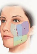 Image result for Flap Inside Cheek