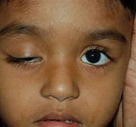 Image result for Ptosis Nerve Damage