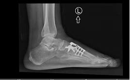 Image result for Lisfranc Orif