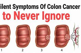 Image result for Cancer De Colon Tac