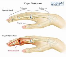 Image result for Dislocated Finger Joint