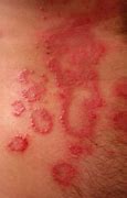 Image result for Small Red Circular Rash On Skin