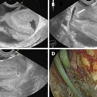 Image result for Biloma Ultrasound Images Post-Cholecystectomy